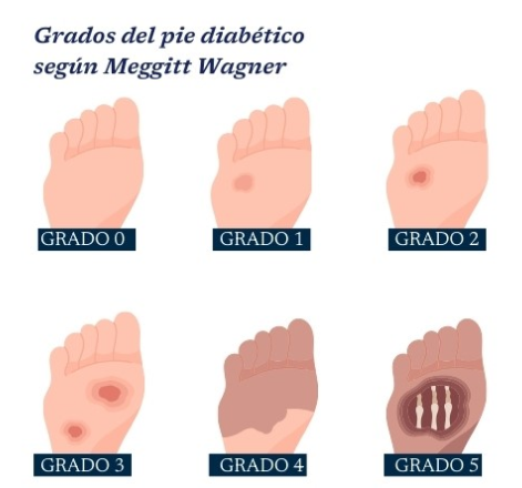 pie diabetico etapas wagner